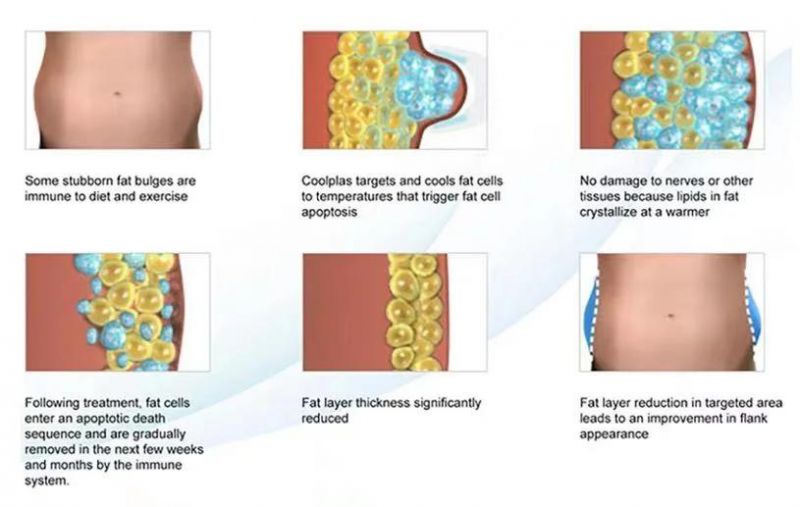 V-Weight Loss Skin Tightening Cellulite Reduction