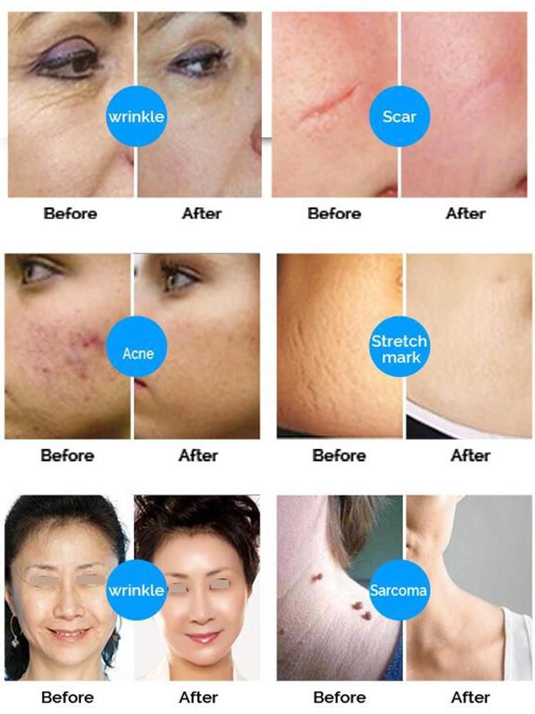 Wrinkle Remover Skin Tightening Fractional CO2 Laser