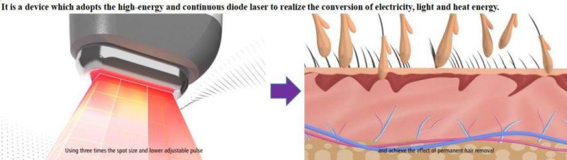 Safe Permanent Hair Removal Machine/ Laser Diode in Laser Light Machine