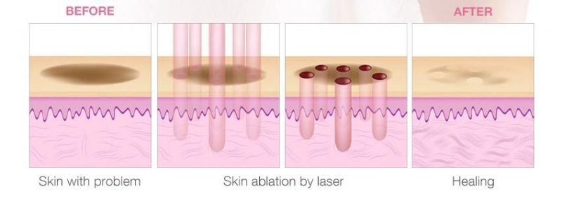 Vaginal Tightening Wrinkle Removal Fractional CO2 Laser Skin Resurfacing Rejuvenation