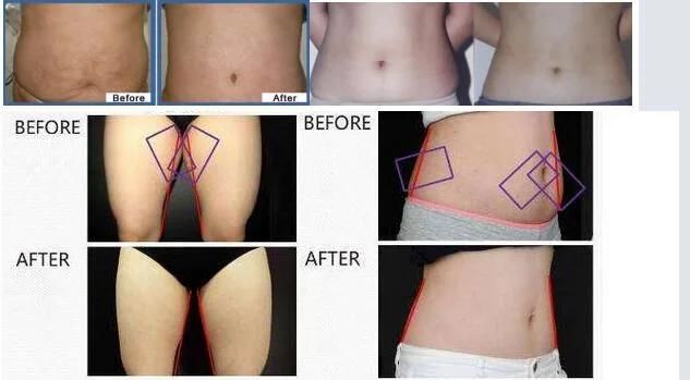 Cryolipolysis System in Clinic & SPA