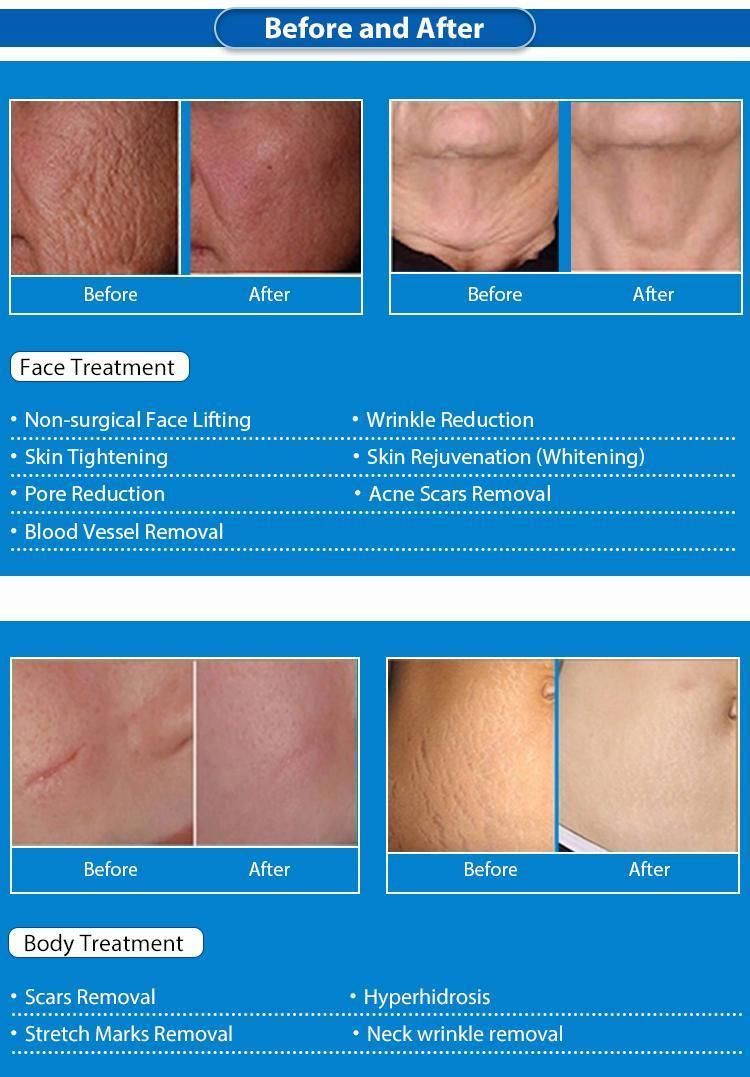 Microneedling Stretch Marks Removal Fractional RF Face Lift Wrinkles Reduction Microneedle Anti Aging Remove Acne Scar Skin Care Treatment