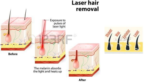 808/810nm Diode Laser Skin Hair Removal Machine