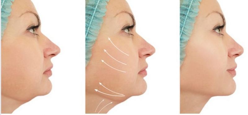 Non-Surgical Best Face and Body Facelift Laser Lifting Face Treatment Facial Sculpting 1470nm Endolift Laser