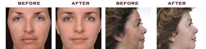 Professional 6 in 1 Multifunctional Hydro Diamond Peeling Skin Rejuvenation Micro Dermabrasion Hydra Beauty Facial Lifting Pores Removal Salon Device