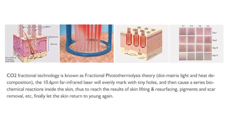 CO2 RF Fractional Laser Skin Rejuvenation and Stretch Marks Removal