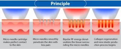 Sincoheren Wrinkle Remover Microneedle Radiofrequency Scarlet Fractional RF Needle Skin Tightening Microneedling Machine