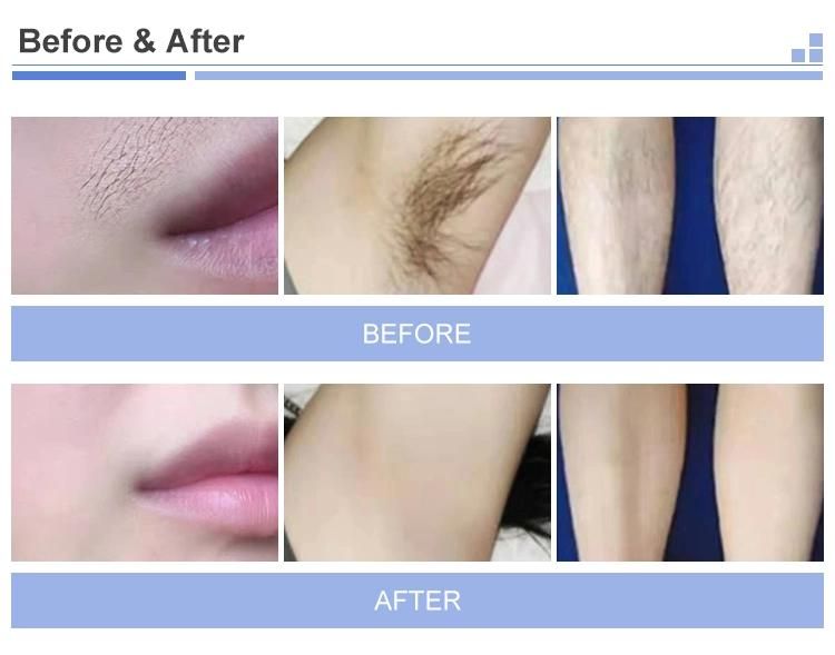 Skin Permanent Hair Removal 755/1064/808nm Laser Hair Removal