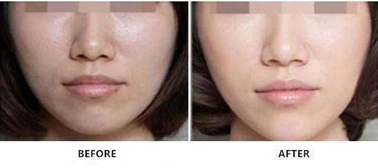 Hyaluronate Acid Dermal Injection Meso Solution to Lighten Dark Circles and Remove Wrinkles