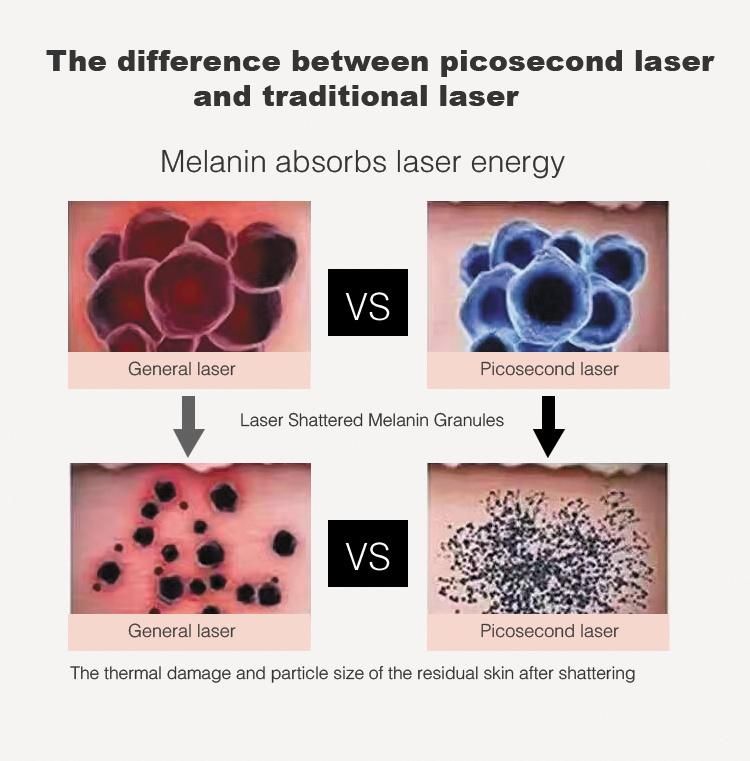 Professional Picosecond Laser Tattoo Removal Machine for Freckles Removal