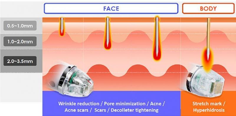 M-Face Lift Skin Rejuvenation Wrinkle Remover RF with Machine