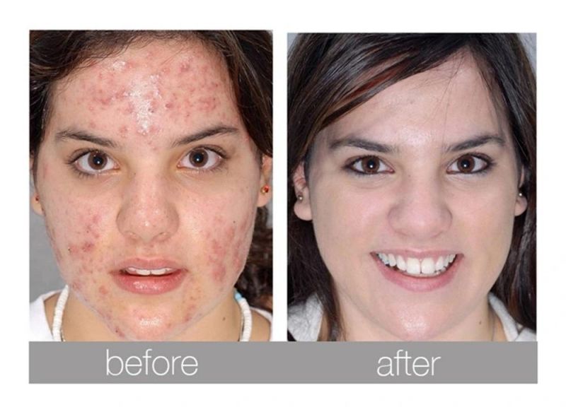 PDT Skin Rejuvenation Anti Acne LED Light Therapy Mask