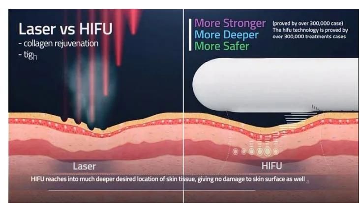 Four Treatment Handles Wrinkles Removal, Face Lifting, Fat Reduction, Vaginal Tightening 4D Hifu