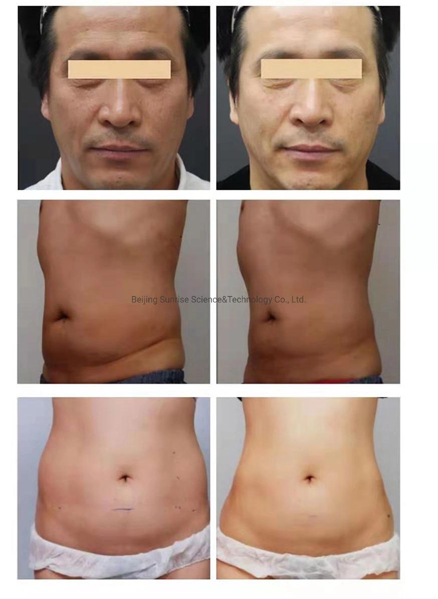 New Developing Technology 7D Hifu Ultra Former Fat Reduction Hifu Cartridges Face Lift Machine 30000 Shots Hifu Wrinkle Removal Anti-Aging