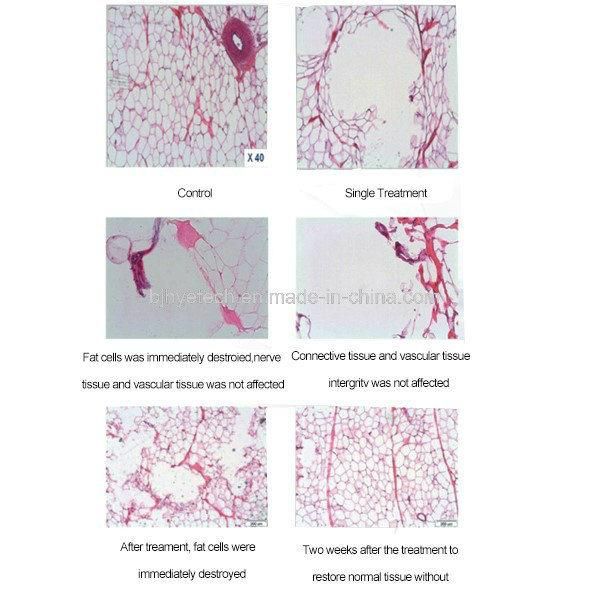 Vertical Non-Invasive Fat Reduction Liposonix Hifu Machine