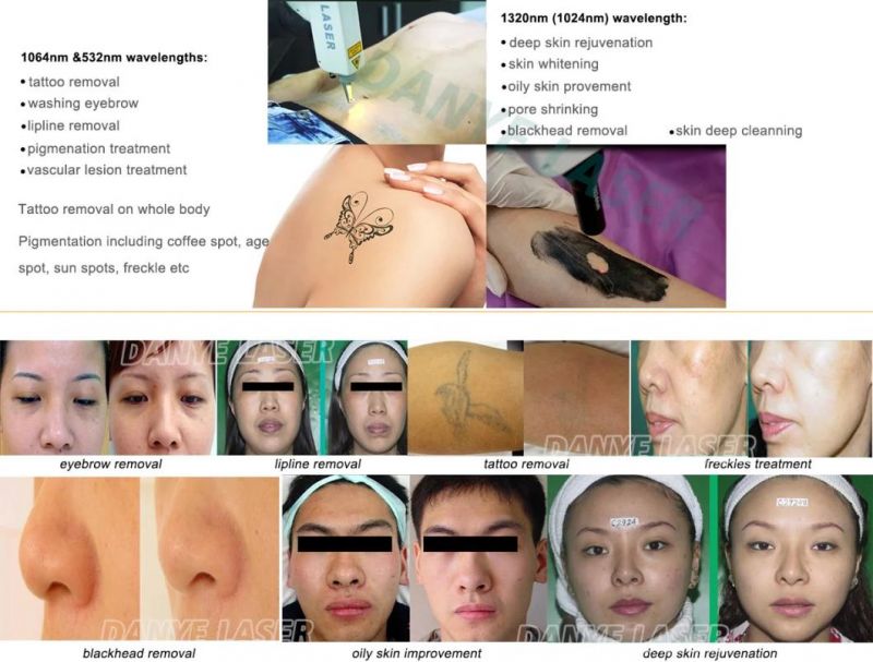 Remove Unwanted Hair Removal Permanently Opt IPL Shr Q-Switched ND YAG Laser Tattoo Removal 2 in 1 Multifunction Laser Beauty Machine