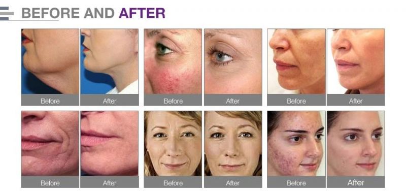 Skin Rejuvenation Acne Treatment Facial Machines Peel Oxygen Jet