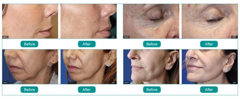 Az RF Micro- Needling Skin Rejuvenation Skin Tightening