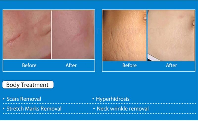 Korea Fractional Microneedle RF/Fractional RF Microneedle Portable for Wrinkle Removal