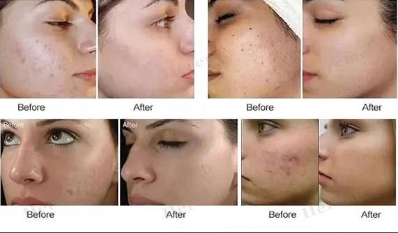 Home Professional Facial Skin Care Acne Elimination Nano Microneedle Instrument