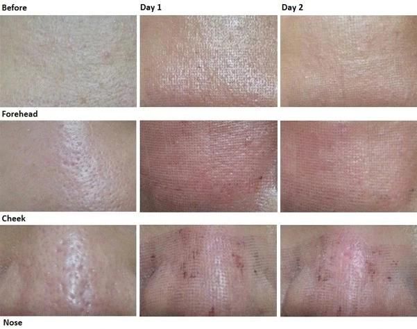 510K FDA CO2 Fractional Laser Skin Resurfacing Vaginal Tightening Machine