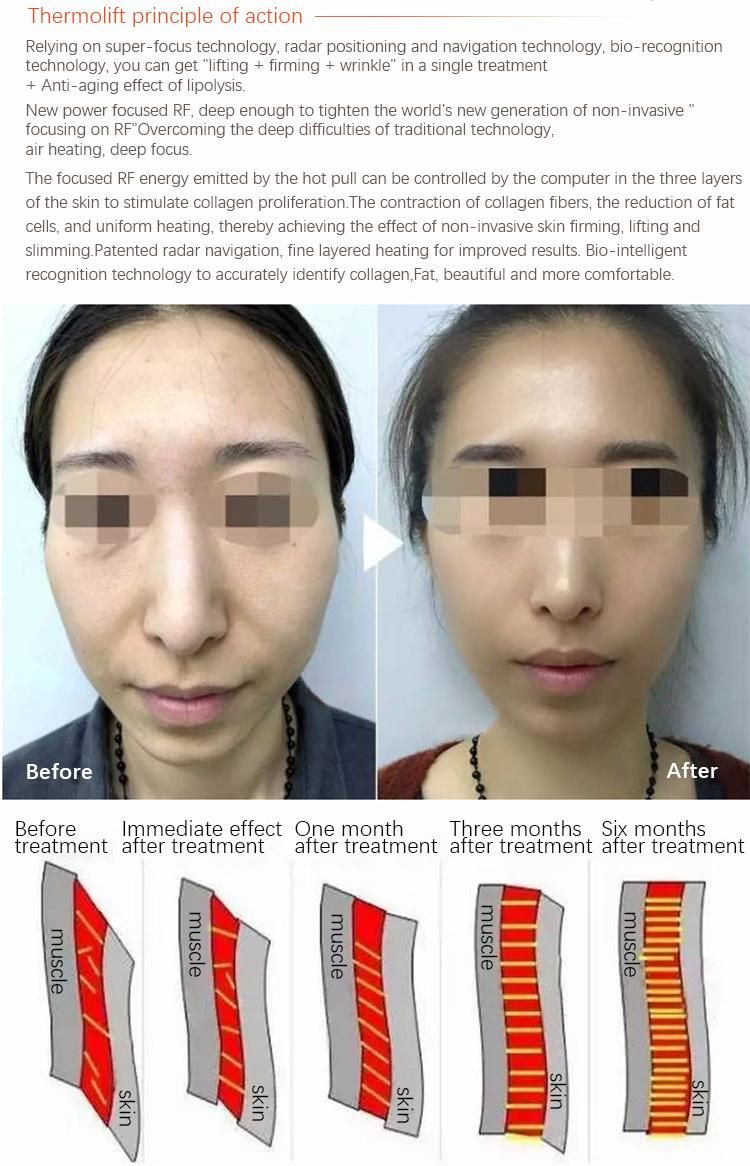 Renlang Thermal RF Wrinkle Removal Machine Facial Lifting China Supplier