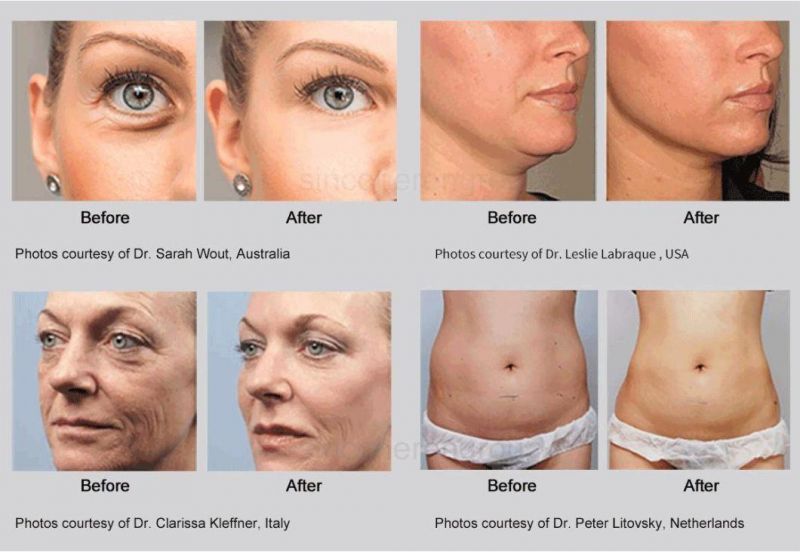 Ultraformer III Hifu for Face and Body Lift Tigten and Contour