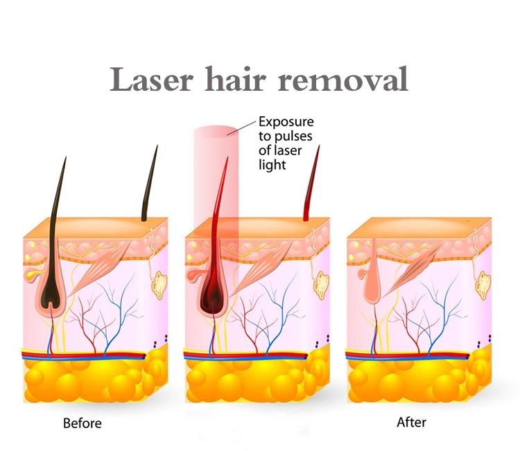 Painless Laser 808nm Machine Hair Removal Chinese Manufacturer