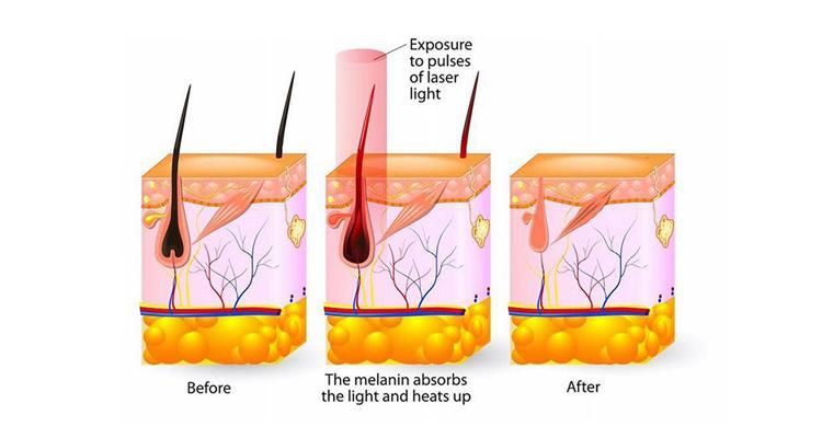 Painless Shr IPL E-Light Laser Hair Removal Machine