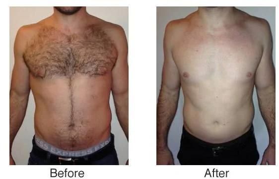 Skin Hair Removal Painless for Home Salon Use Beauty Equipment