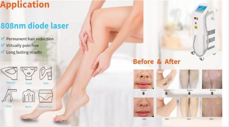 Beijing Sincoheren 755+808+1064 Nm Laser Hair Removal with CE Certification