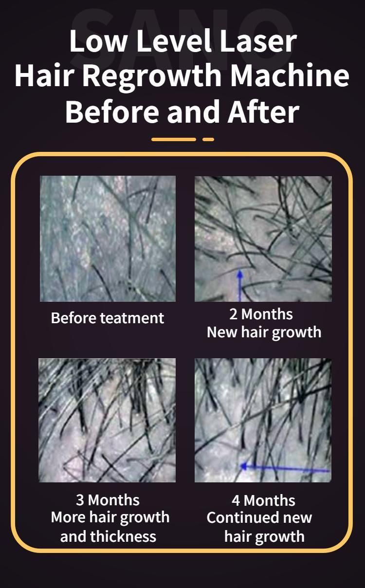 Sanhe Laser Low Level Laser Hair Growth Beauty Equipment