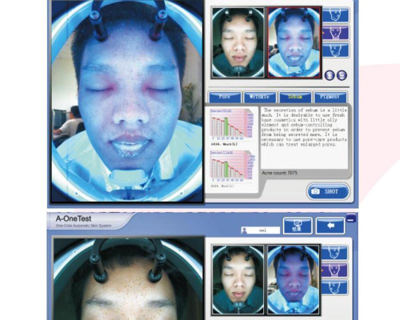 Portable Digital Facial Skin Analyzer for Acne Removal (CE approval)