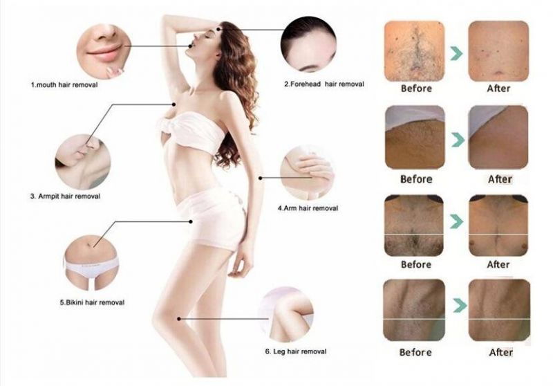 808nm Diode Laser Permanent Hair Removal with Germany Laser Bar