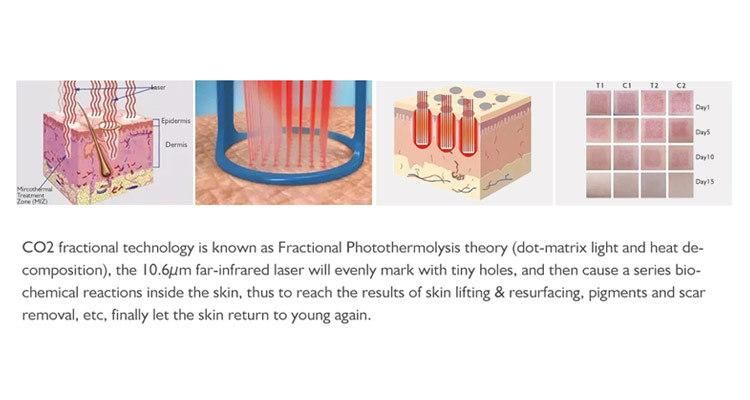 RF Metal Tube Fractional Laser for Skin Rejuvenation