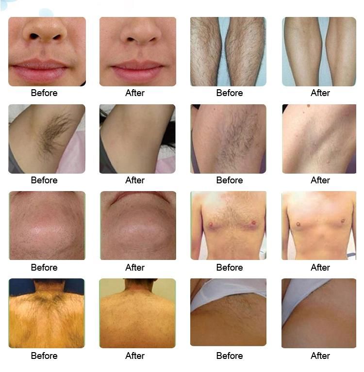 Germany New Technology 3 Wavelength 808 755 1064 Diode Laser Hair Removal