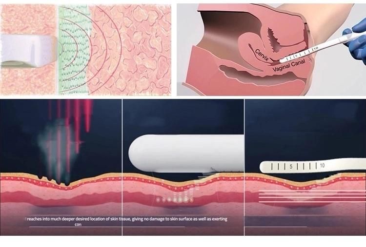 Portable Thermiva RF Vaginal Tighten Device