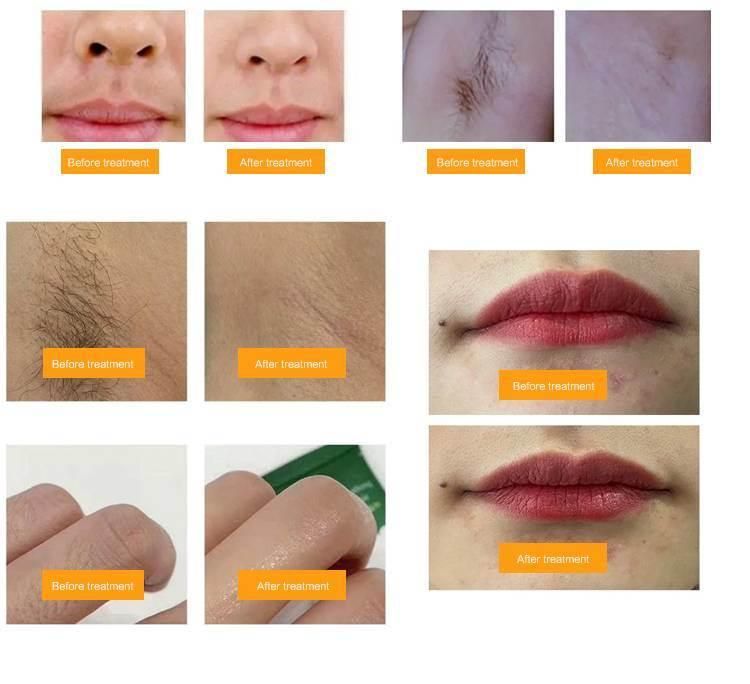 2022 New Factory Price Beauty Machine Clinically Proven Effective 3 Wavelengths Diode Laser Hair Removal Machine