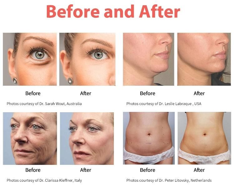 Consultant Dr. Sincoheren 5D Hifu Facial Lifting and Body Slimming