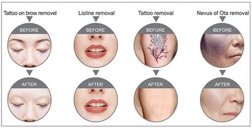 Cheap Price Q Switch ND-YAG Laser Machine for Tattoo Removal