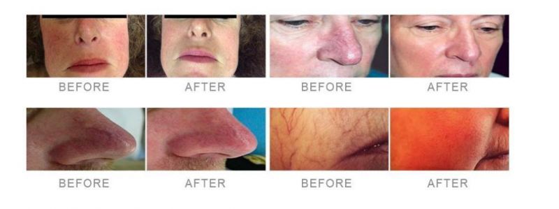 Skin Rejuvenation 980 Diode Laser