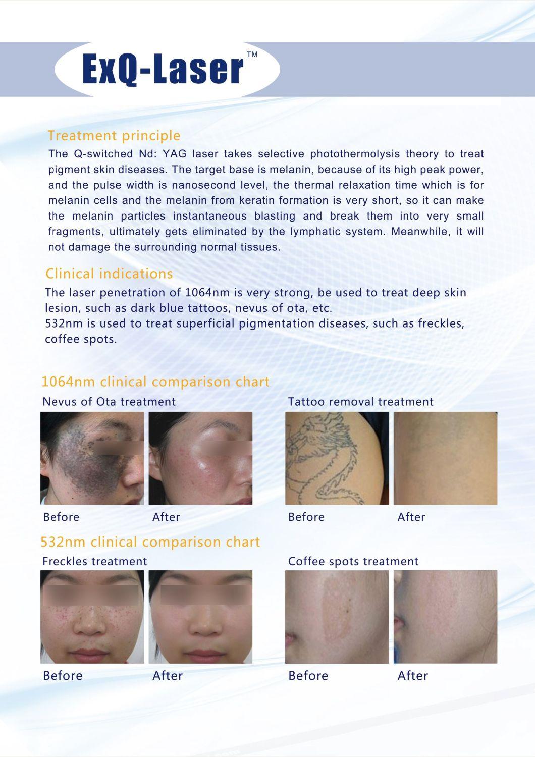 2019 Muilt-Function Q-Switch ND YAG Laser for Carbon Peeling Treatment for Skin Rejuvenation