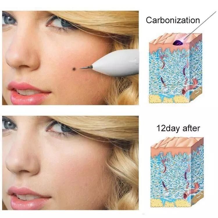 Plasma Pen Beauty Laser Spot Pen/Freckle Pen/Mole Remover