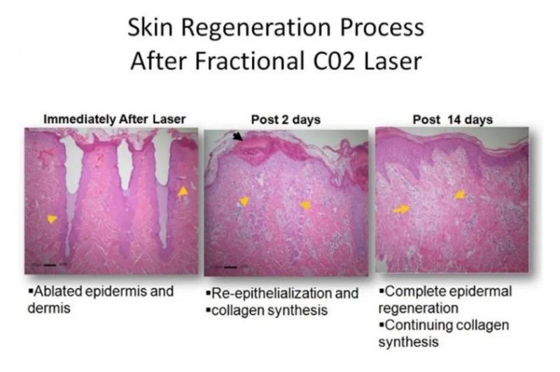 Scar Removal CO2 Laser Therapy System for Skin Rejuvenation Pigmentation Removal Exmatrix