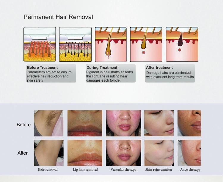 Shr IPL Hair Removal Portable - Looking for Exclusive Distributor