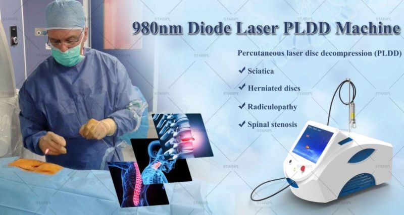 2021 Beijing Starlight Pldd Lumbar Disc Laser Medical Evlt Machine