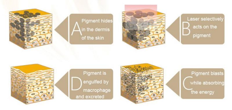 Most Popular ND YAG Laser for Tattoo Removal and Carbon Peeling